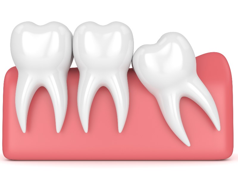 Tooth Extractions in Hoover Copper Leaf Dental Co.